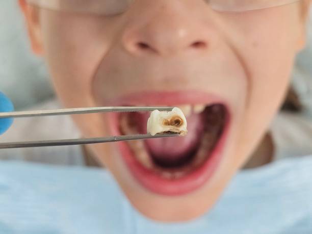 Best After-Hours Dental Trauma Care in Glencoe, MN